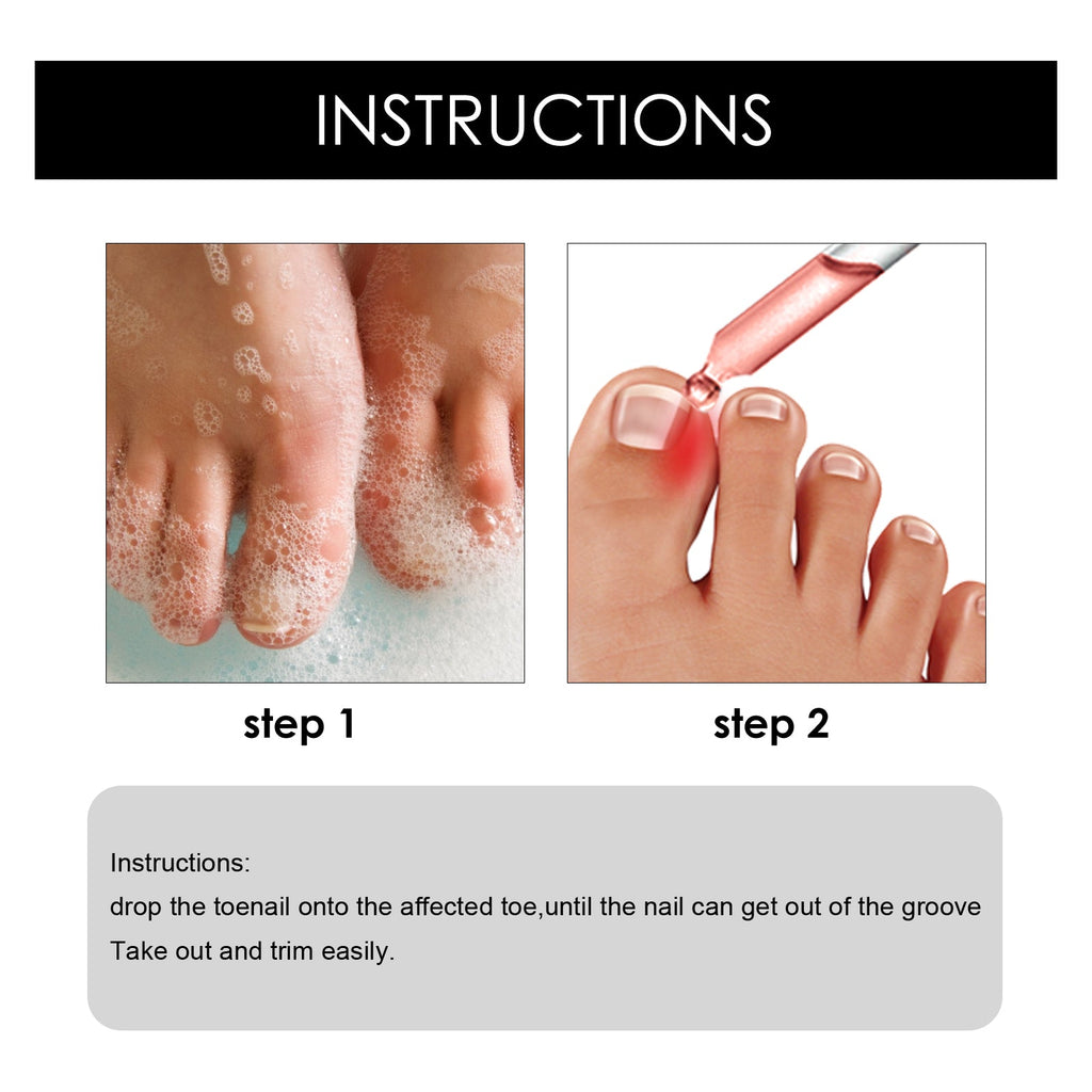 South Moon - Ingrown Toenail Repair
