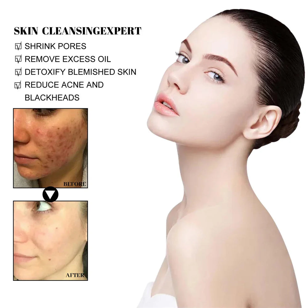West & Month - Mugworts Acne Clay Stick