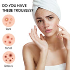 Jaysuing - Pimple Patch Professional Grade